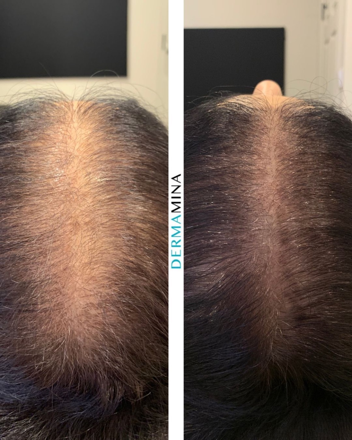 Mesotherapy for hair before and after at Dermamina London, a widened parting filled in with denser hair