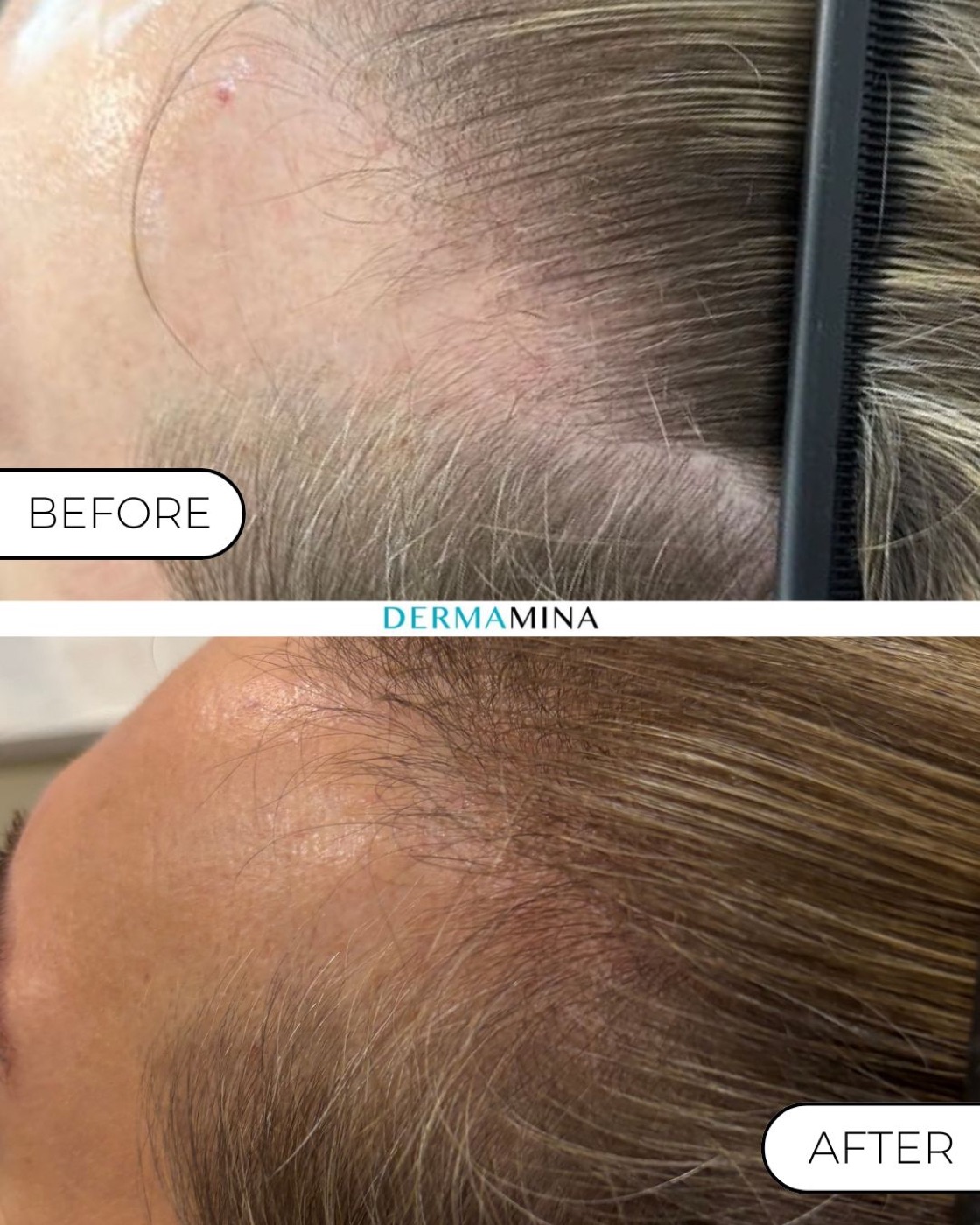 Mesotherapy for hair before and after at Dermamina London, regrowth along a thinning temple and hairline