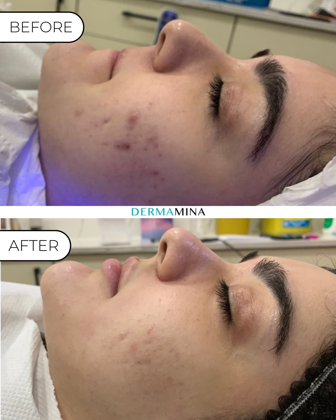 SkinPen microneedling before and after at Dermamina London, active breakouts and marks calmed across the cheek