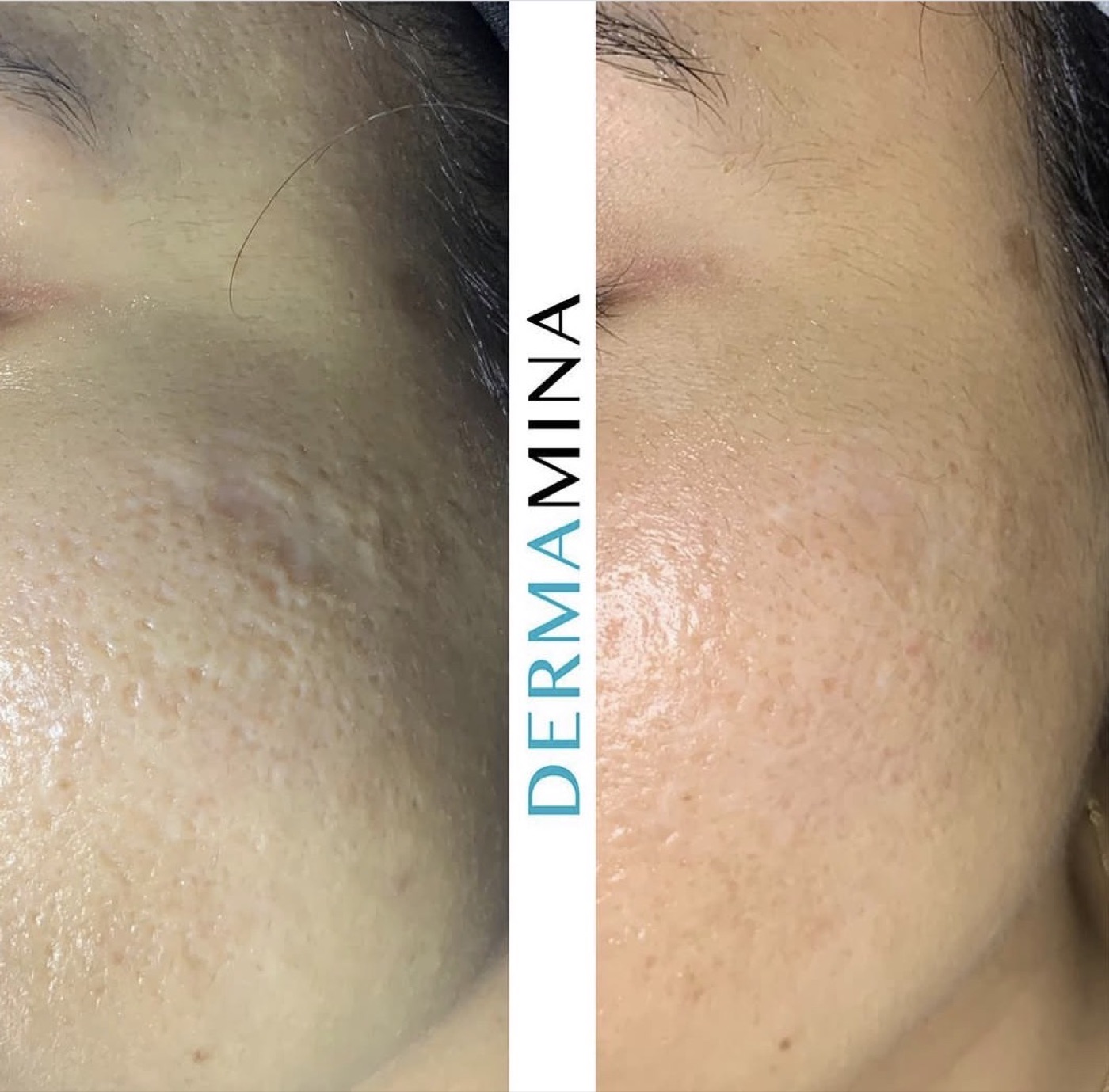 SkinPen microneedling before and after at Dermamina London, indented acne scarring and enlarged pores on the cheek