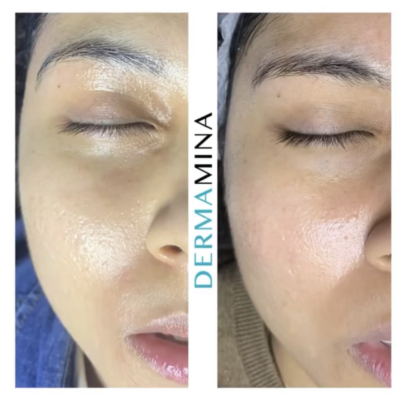 SkinPen microneedling before and after at Dermamina London, smoother texture and more even tone across the cheek and under-eye