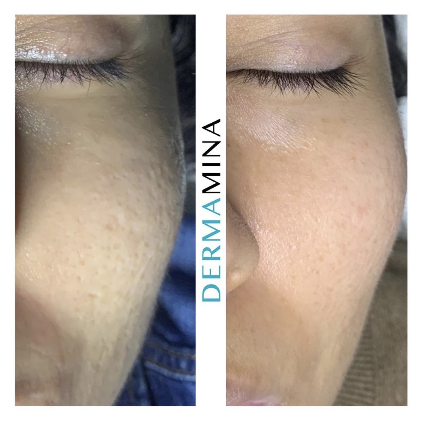 SkinPen microneedling before and after at Dermamina London, refined pores and smoother skin surface on the cheek