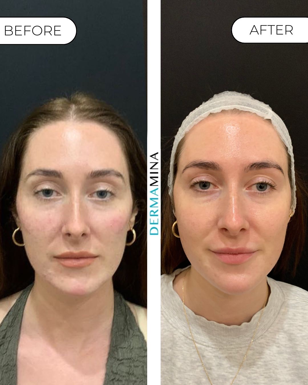 SkinPen microneedling before and after at Dermamina London, calmer skin and more even tone across the full face