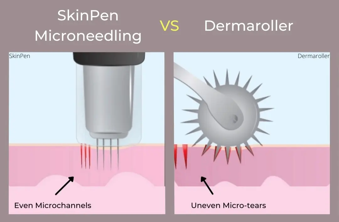 Why Choose Skinpen® Precision Microneedling?