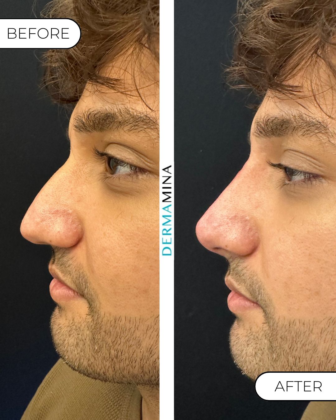 Before and After