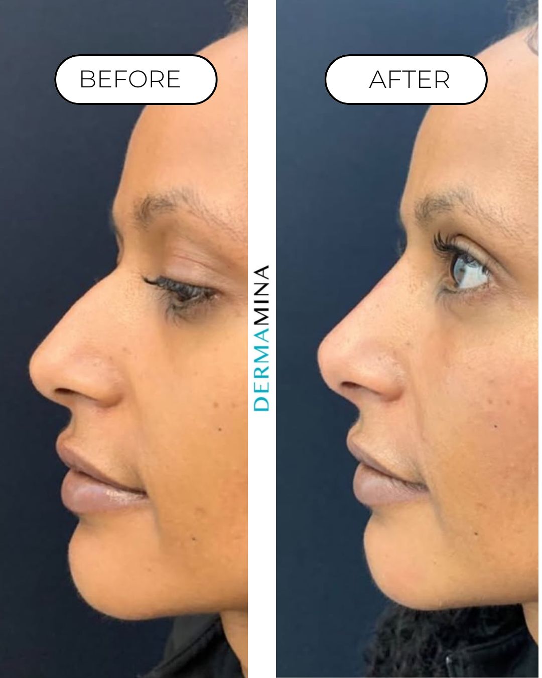 Non-surgical nose job before and after at Dermamina London, balanced, natural-looking profile