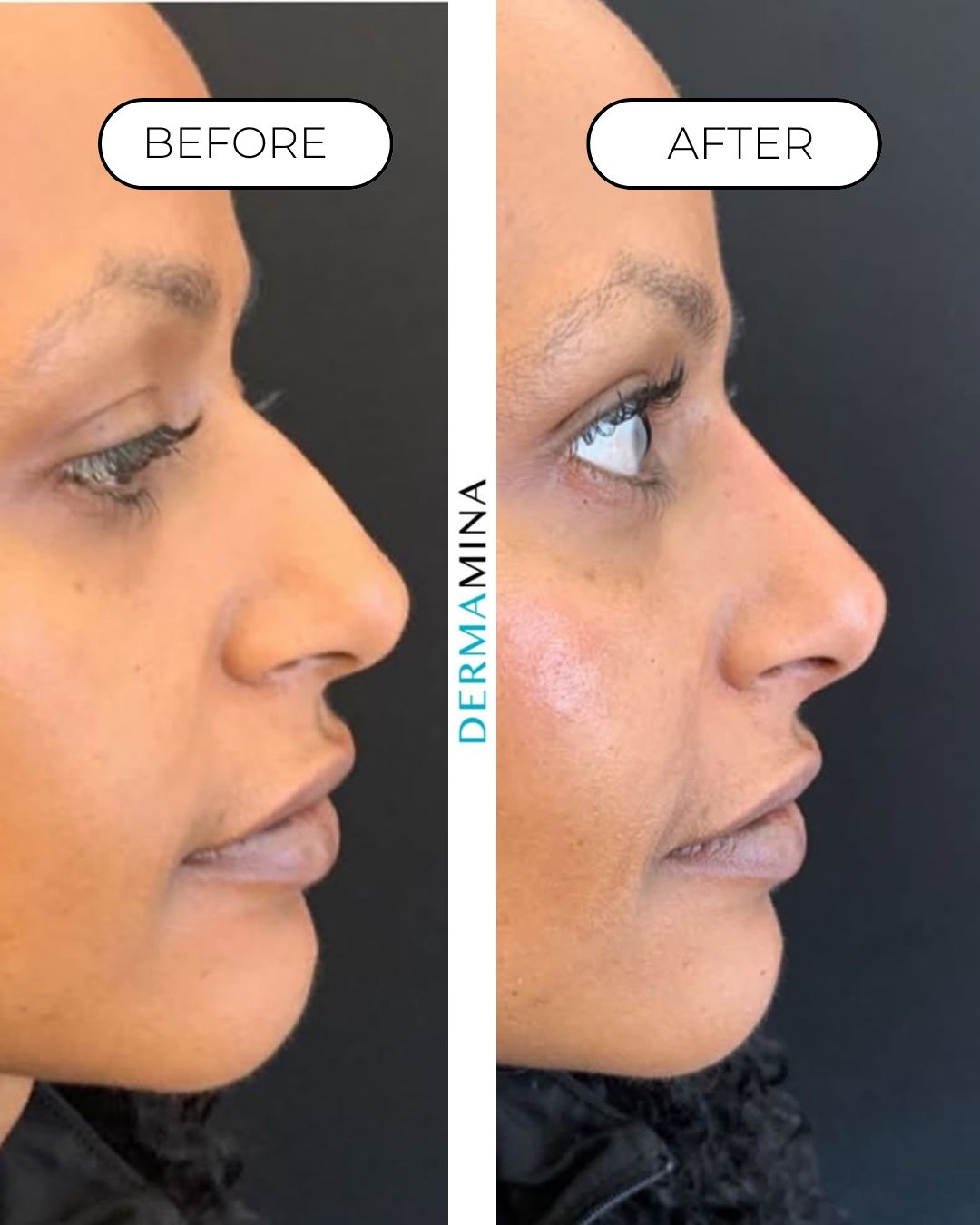 Non-surgical nose job before and after at Dermamina London, balanced, natural-looking profile