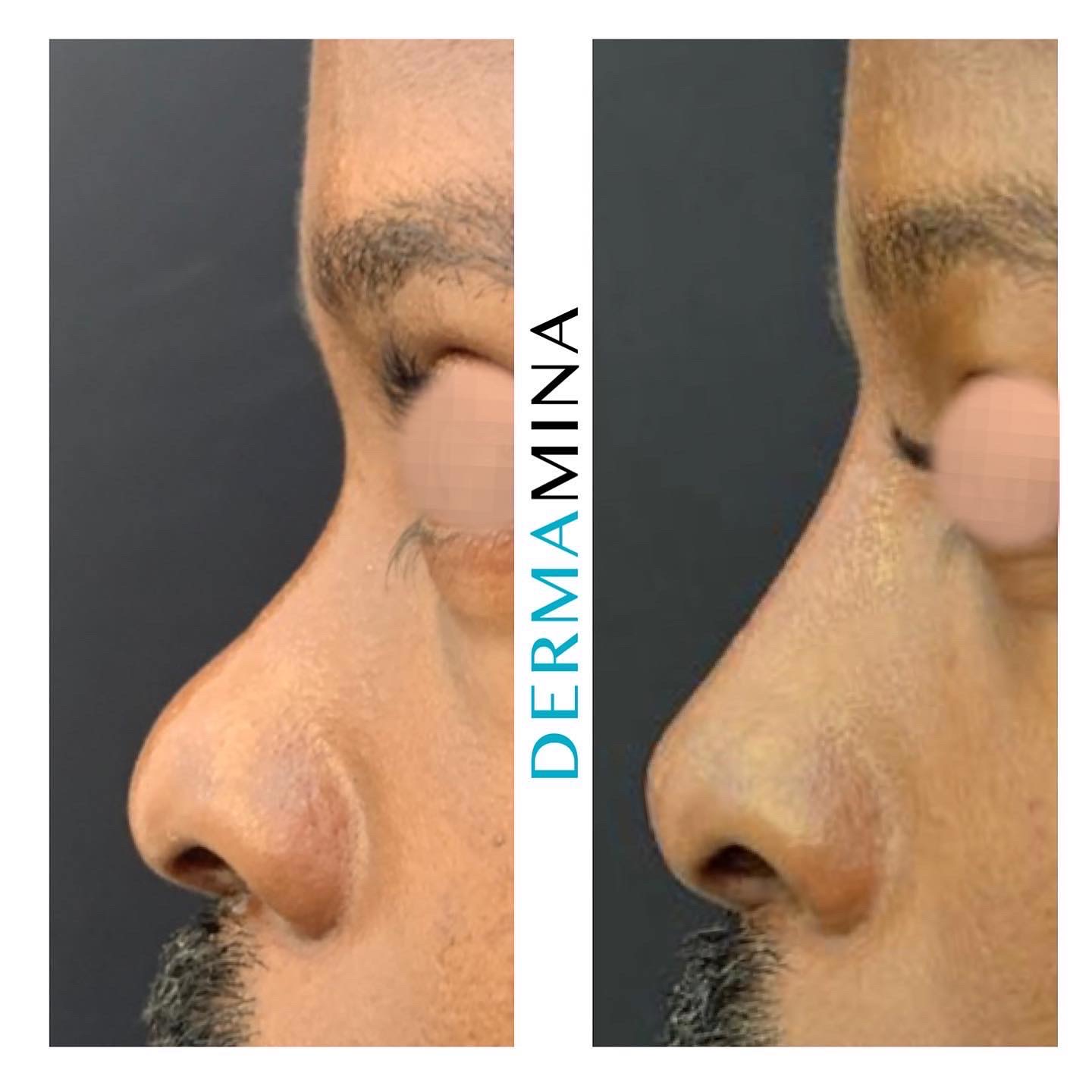 Non-surgical nose job before and after at Dermamina London, balanced, natural-looking profile
