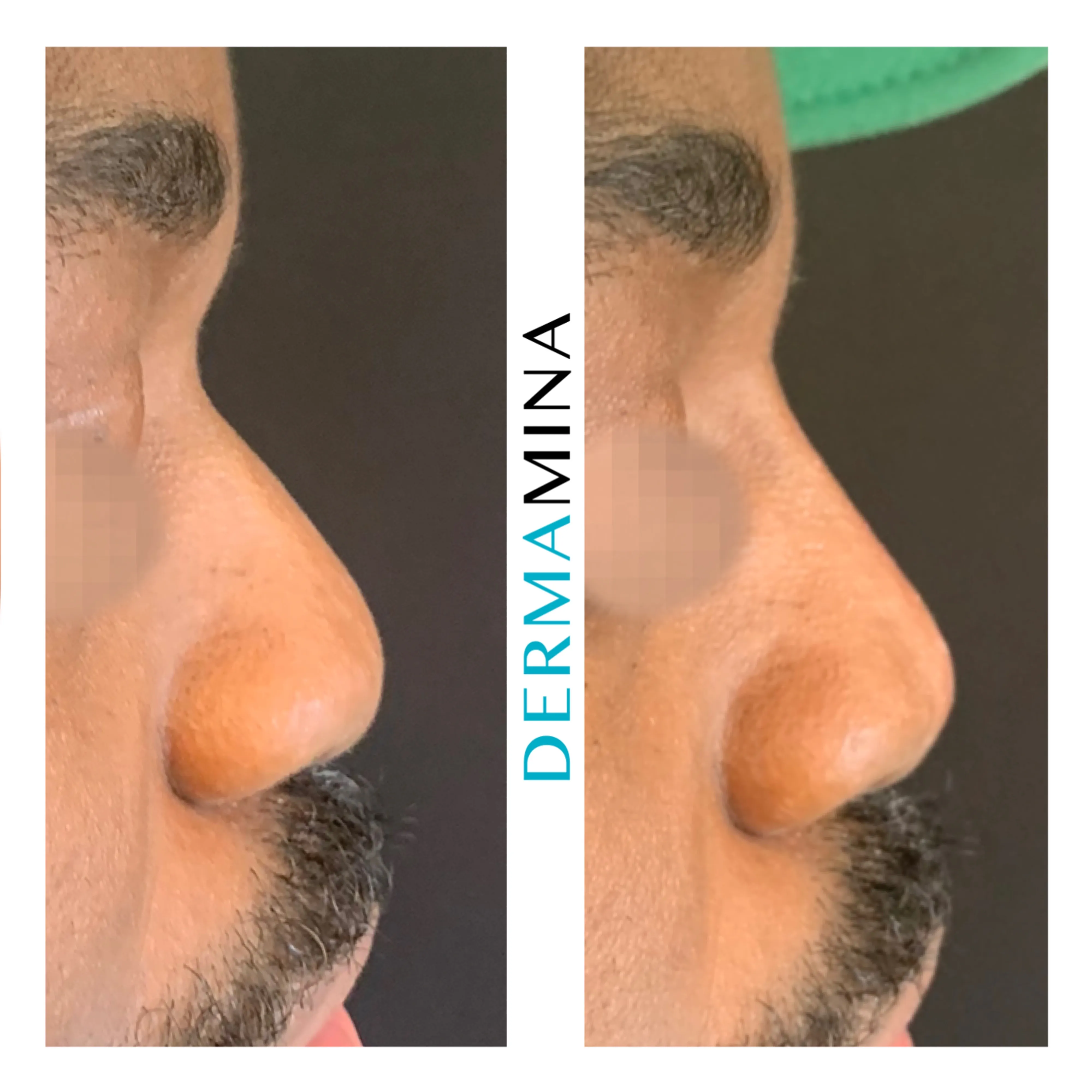 Non-surgical nose job before and after at Dermamina London, balanced, natural-looking profile