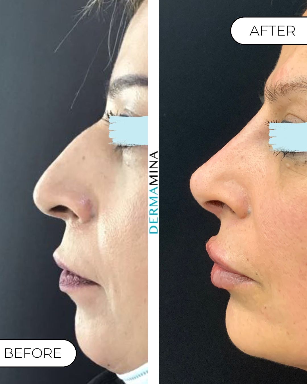 Non-surgical nose job before and after at Dermamina London, balanced, natural-looking profile