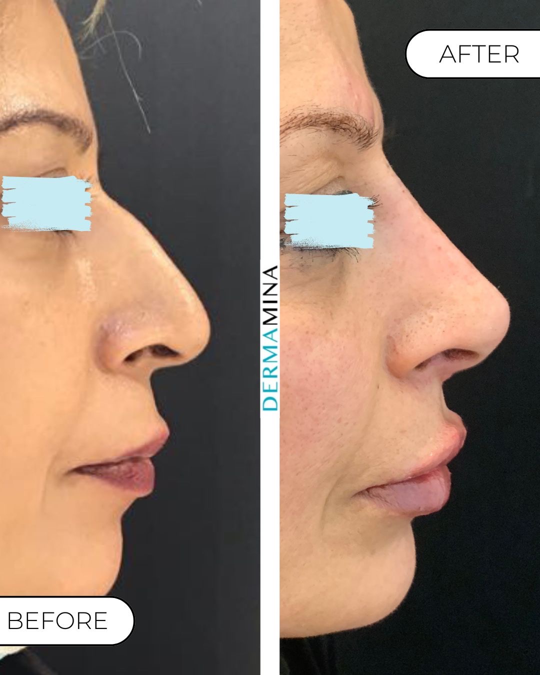 Non-surgical nose job before and after at Dermamina London, balanced, natural-looking profile