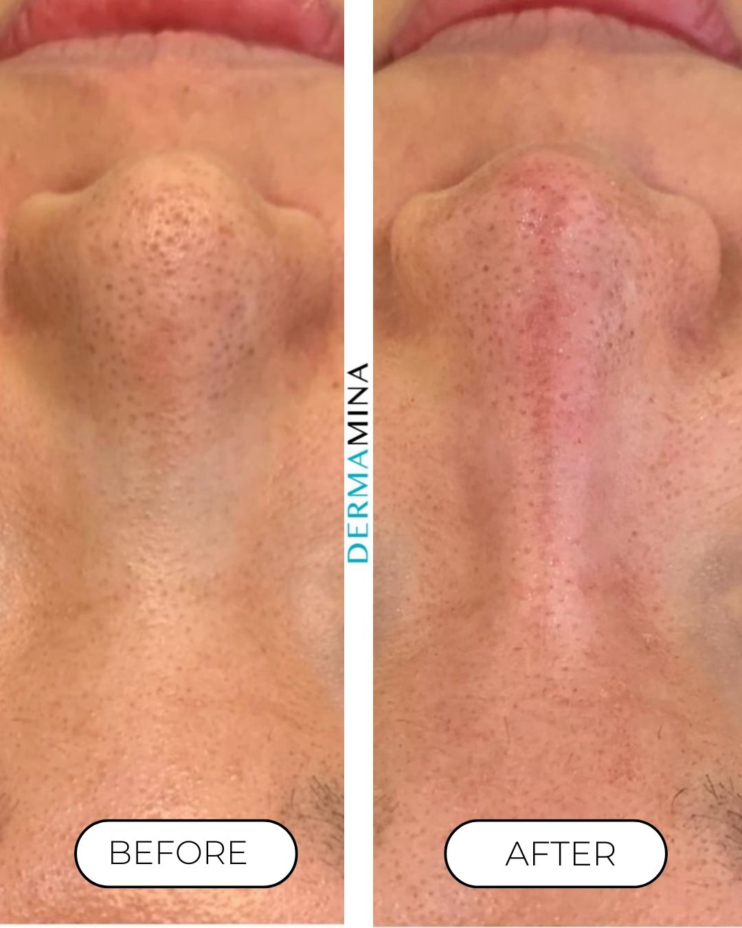 Non-surgical nose job before and after at Dermamina London, balanced, natural-looking profile