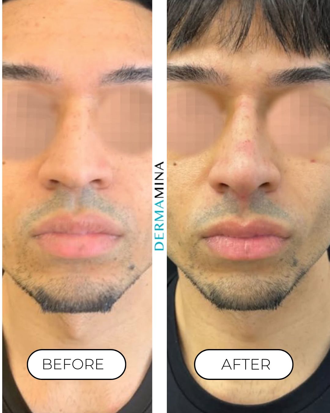 Non-surgical nose job before and after at Dermamina London, flat bridge built up and defined