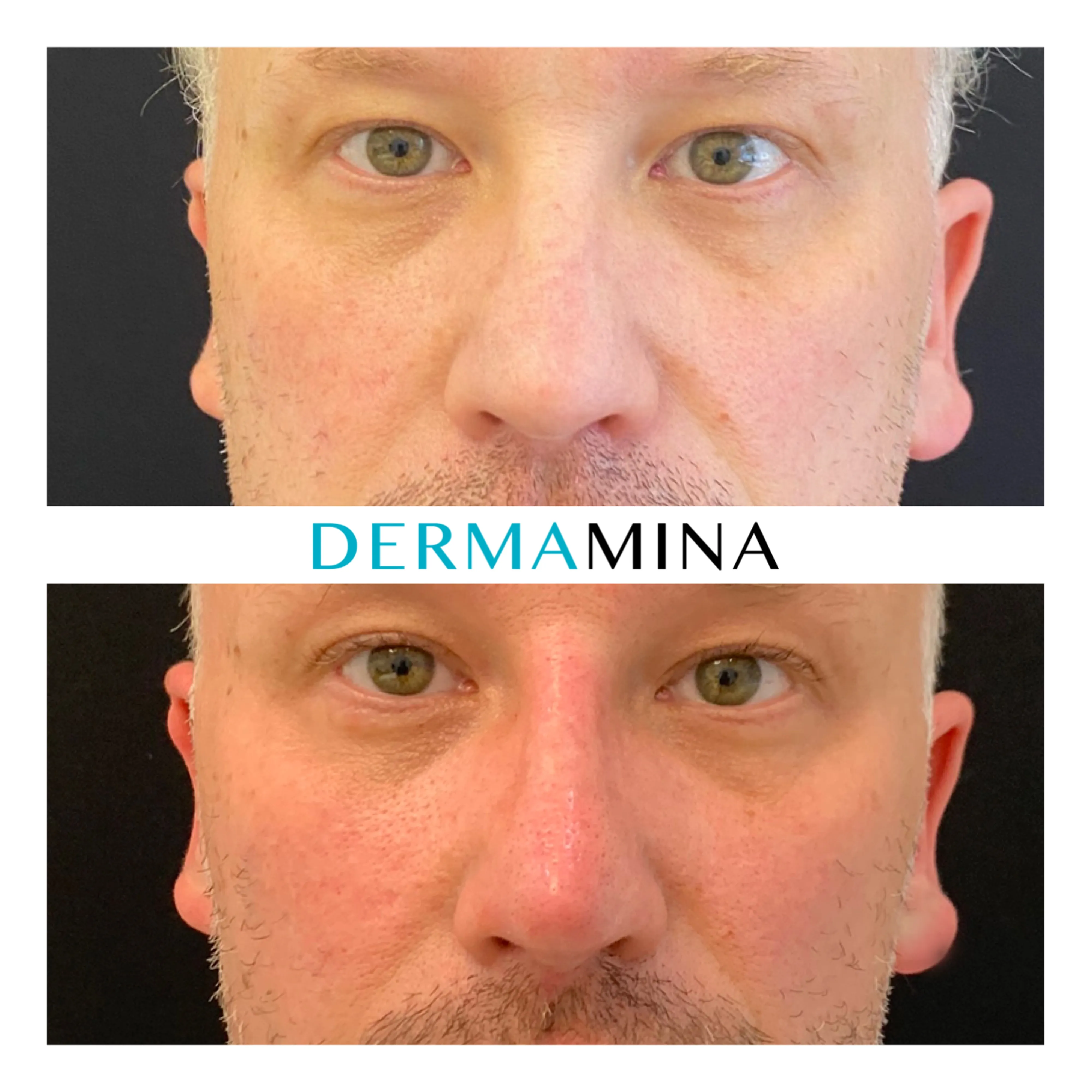 Non-surgical nose job before and after at Dermamina London, flat bridge built up and defined