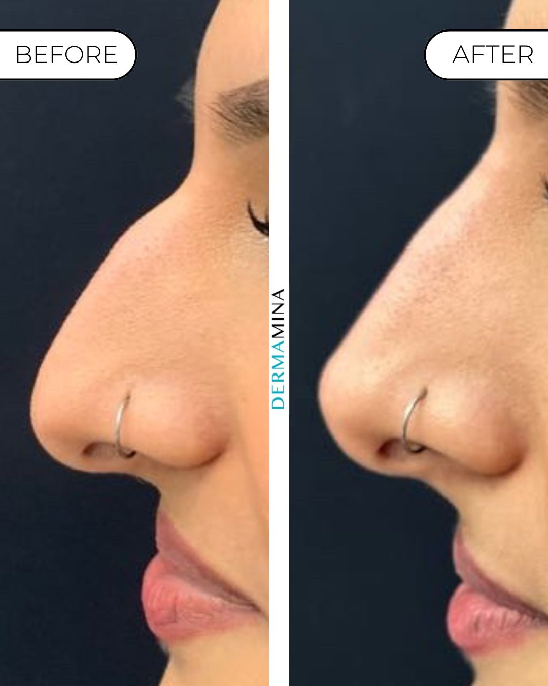 Non-surgical nose job before and after at Dermamina London, dorsal bump smoothed