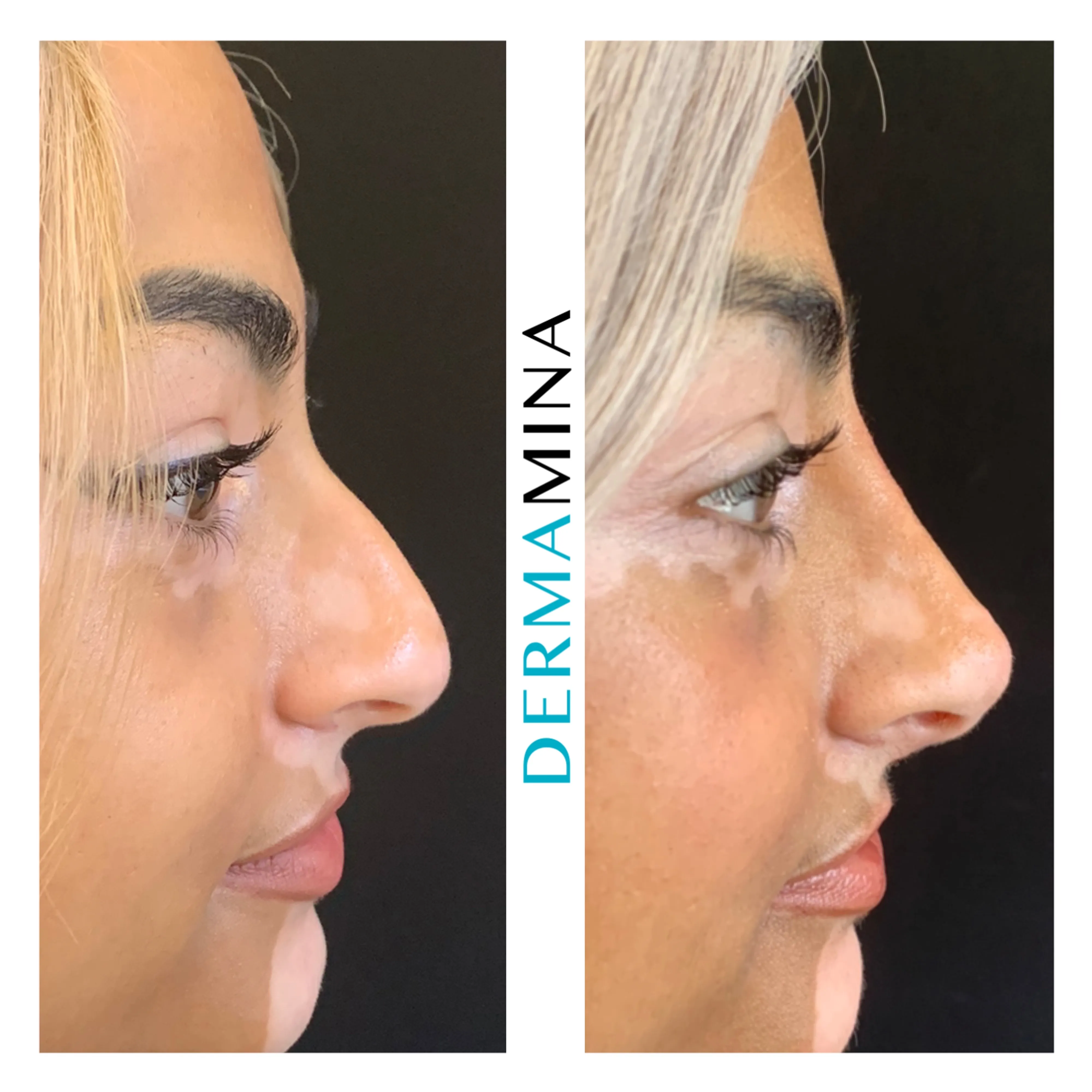 Non-surgical nose job before and after at Dermamina London, hooked profile straightened