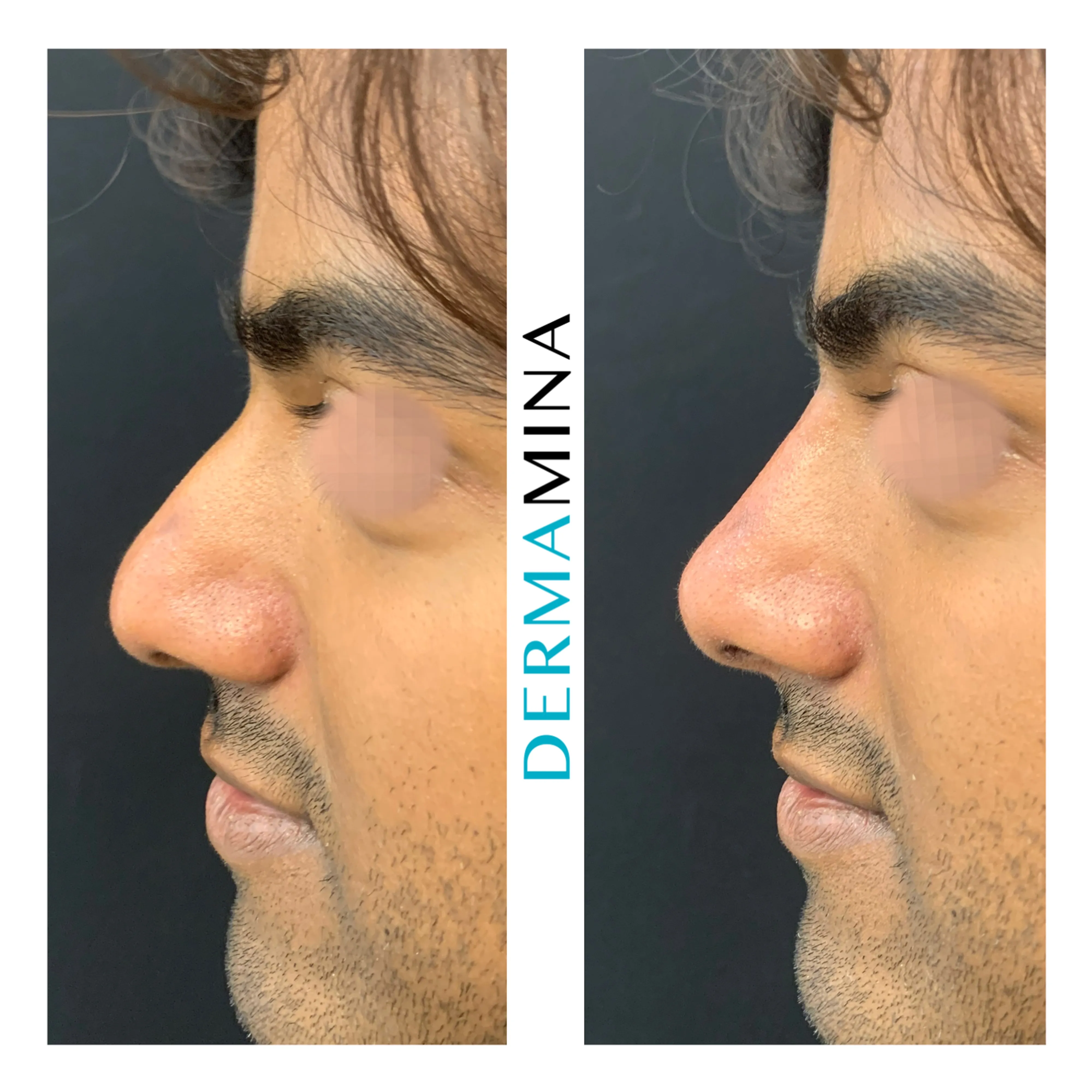 Non-surgical nose job before and after at Dermamina London, hooked profile straightened