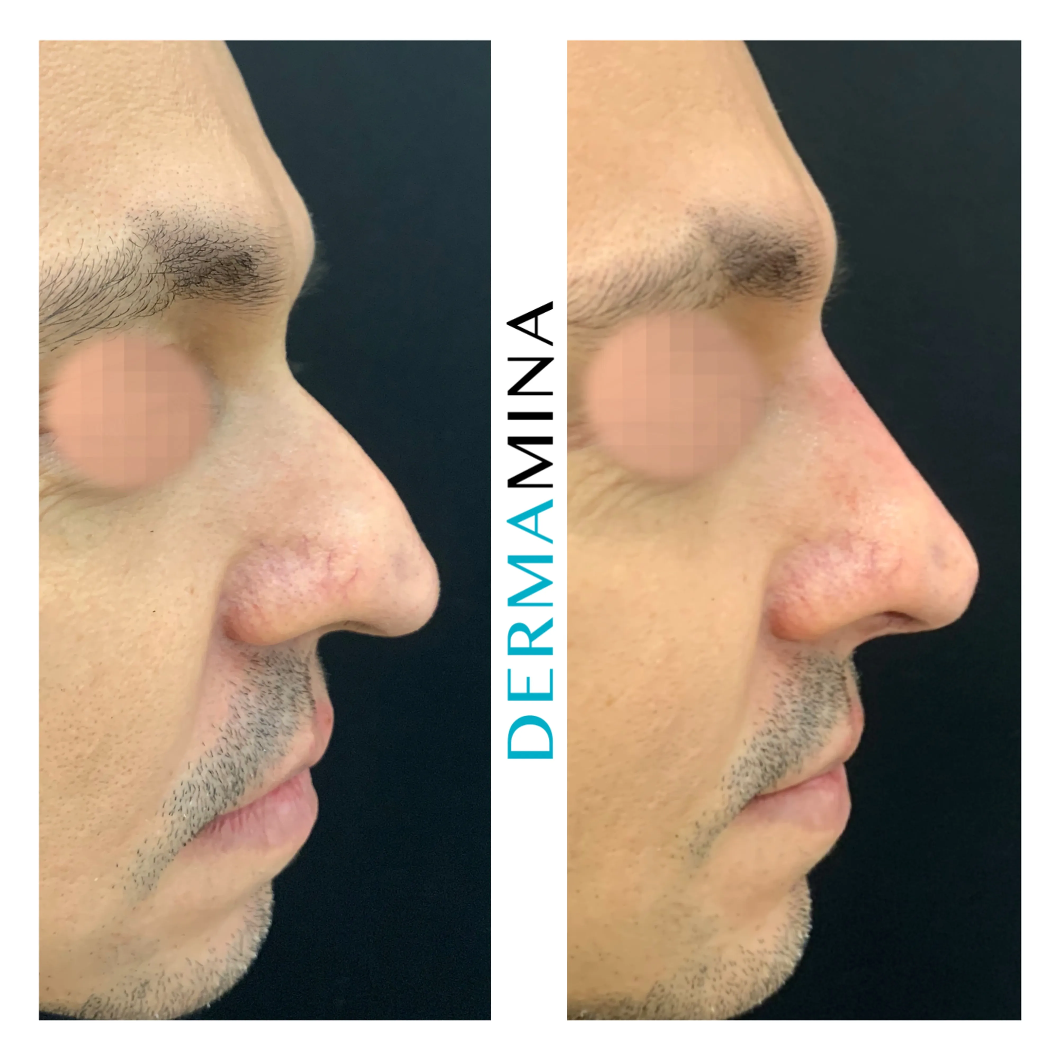 Non-surgical nose job before and after at Dermamina London, hooked profile straightened