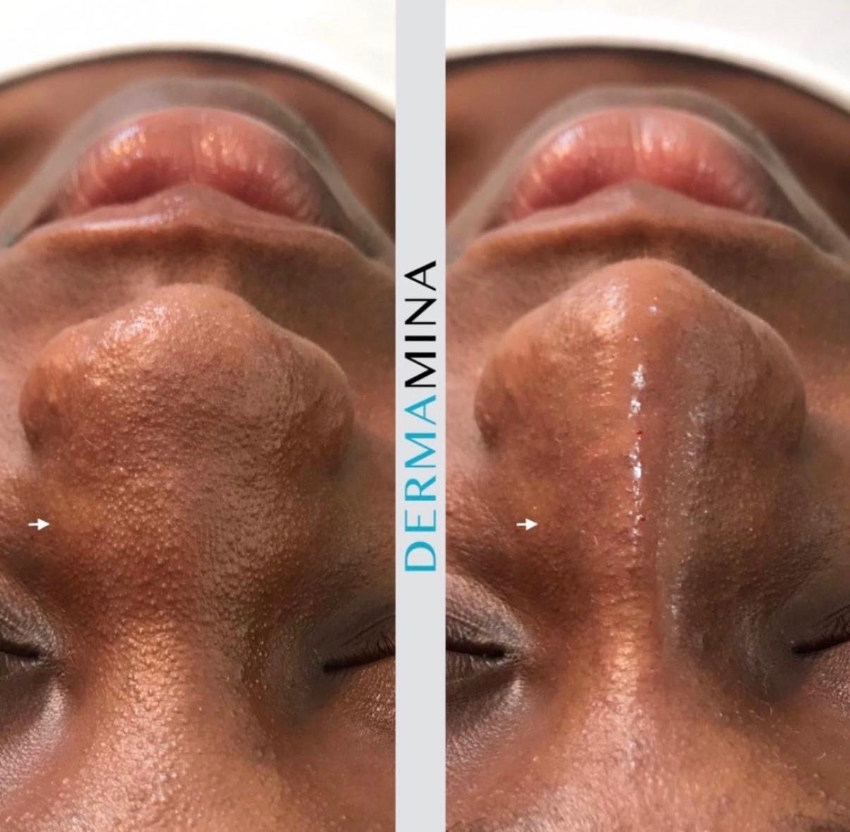 Non-surgical nose job before and after at Dermamina London, wide nose slimmed and narrowed