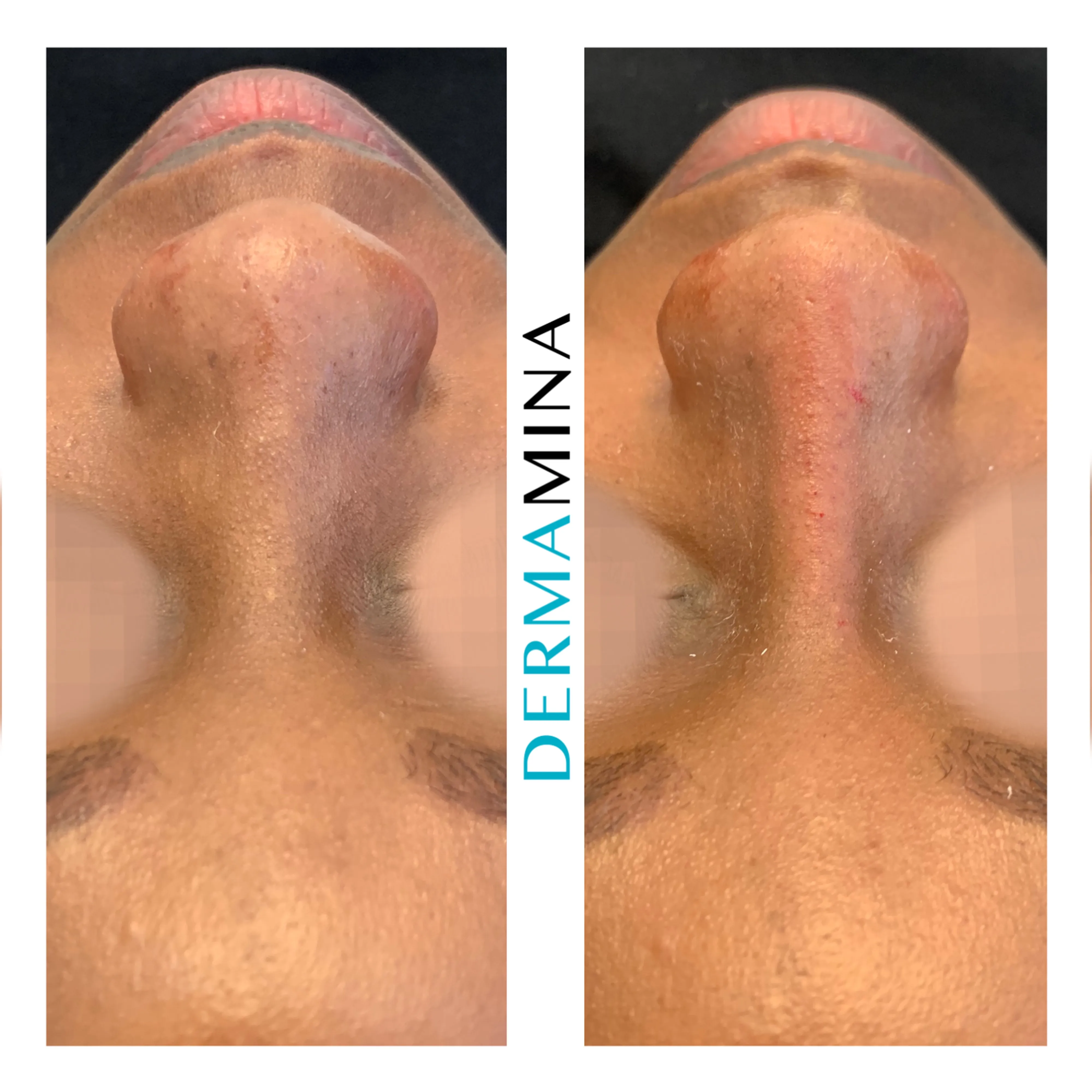 Non-surgical nose job before and after at Dermamina London, wide nose slimmed and narrowed