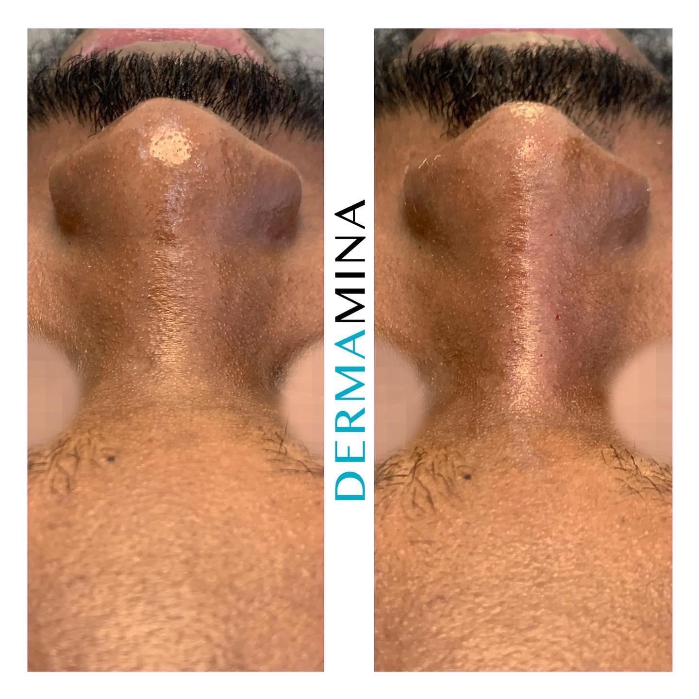 Non-surgical nose job before and after at Dermamina London, wide nose slimmed and narrowed