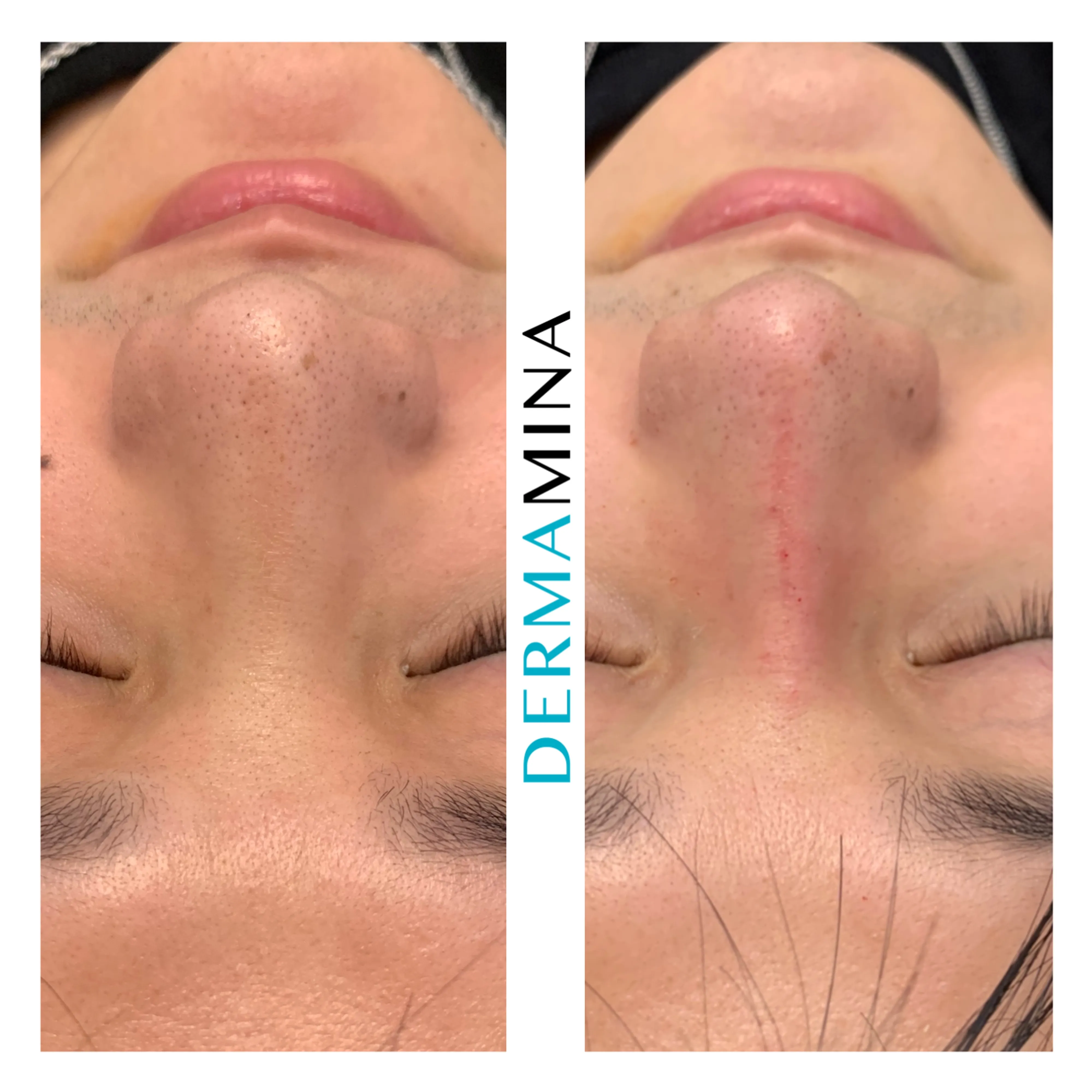 Non-surgical nose job before and after at Dermamina London, wide nose slimmed and narrowed