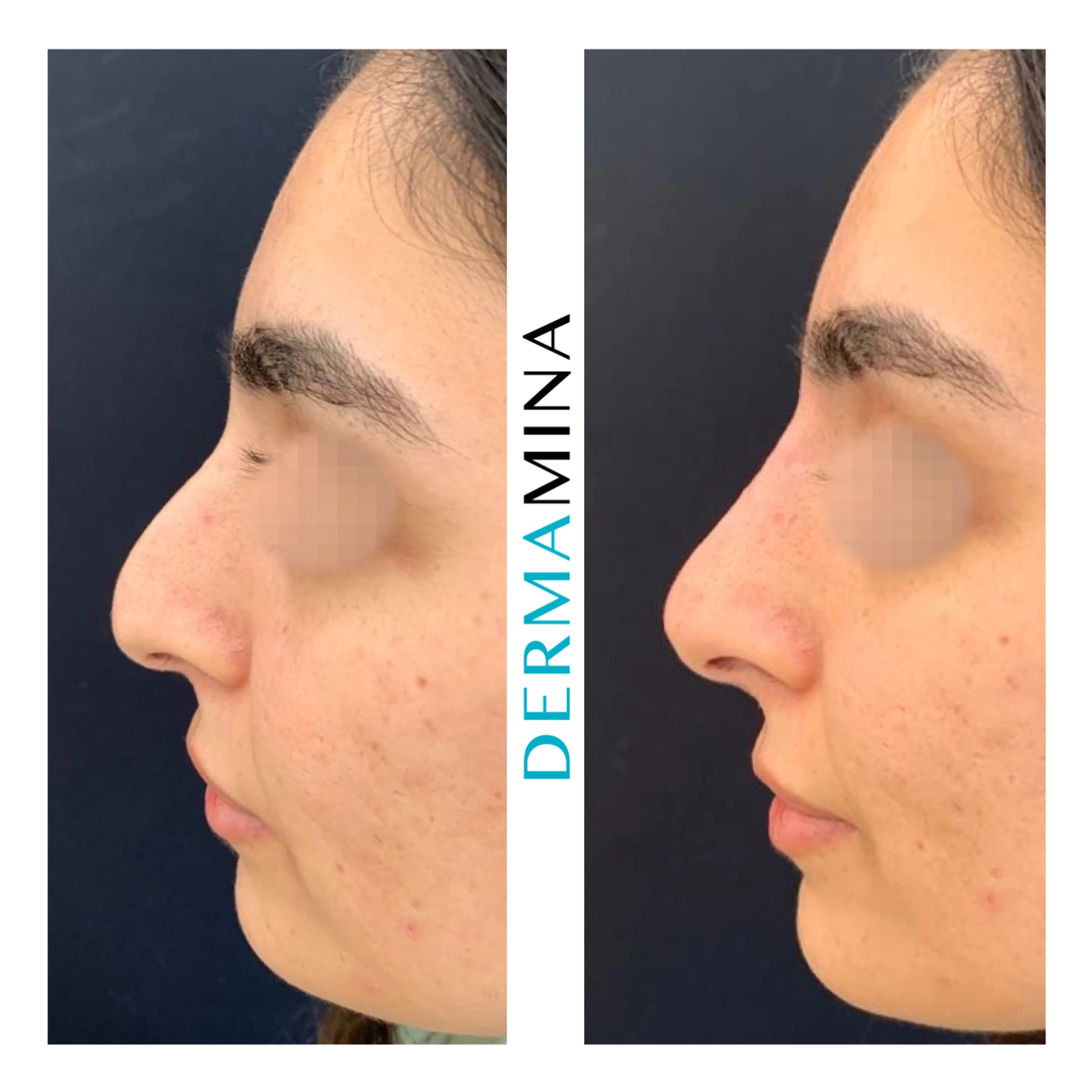 Non-surgical nose job before and after at Dermamina London, droopy tip lifted and refined