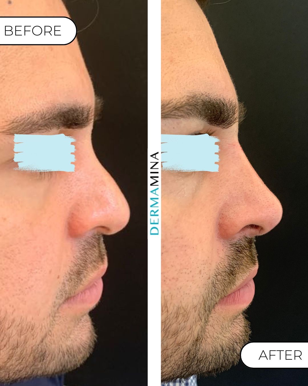 Non-surgical nose job before and after at Dermamina London, droopy tip lifted and refined