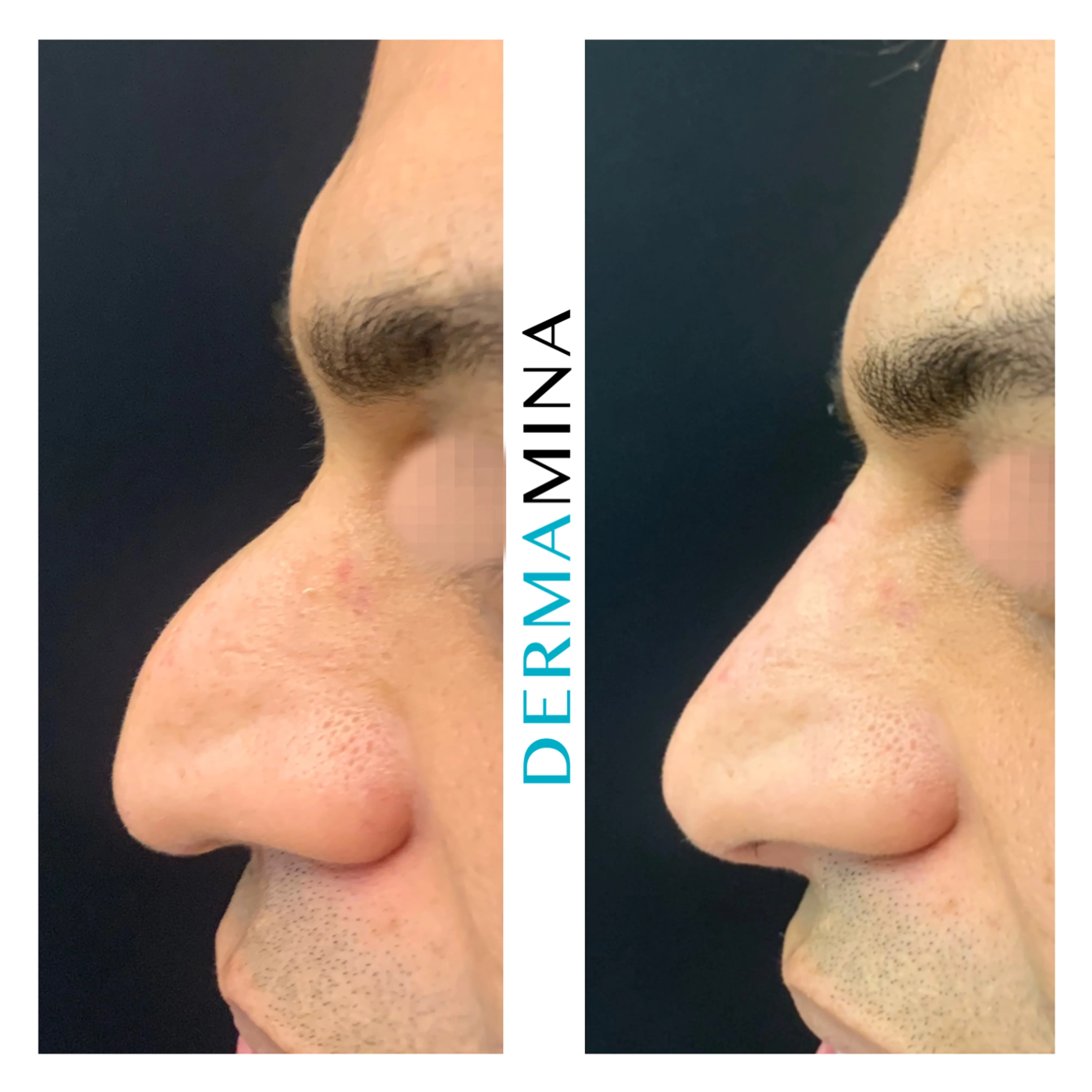 Non-surgical nose job before and after at Dermamina London, droopy tip lifted and refined
