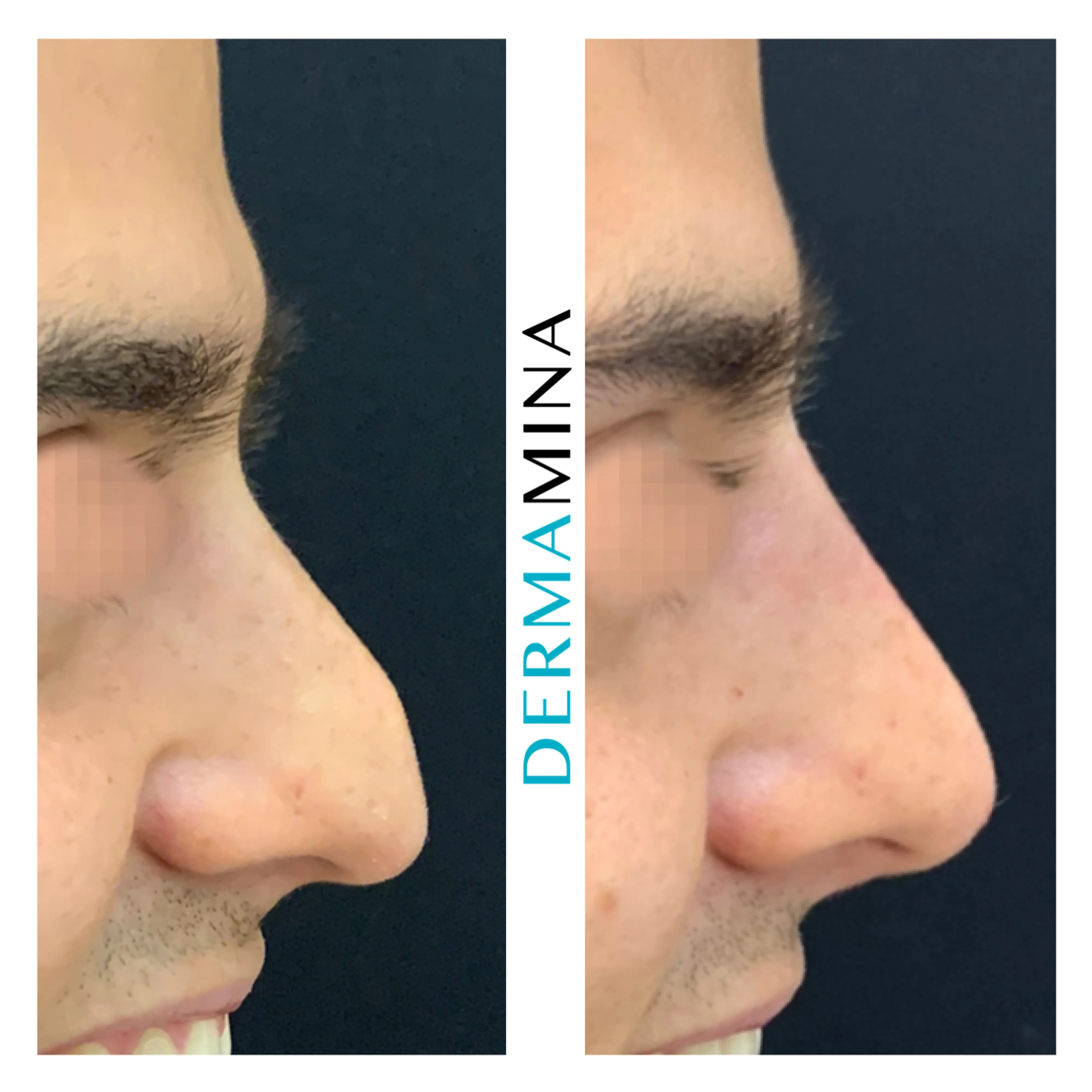 Non-surgical nose job before and after at Dermamina London, droopy tip lifted and refined