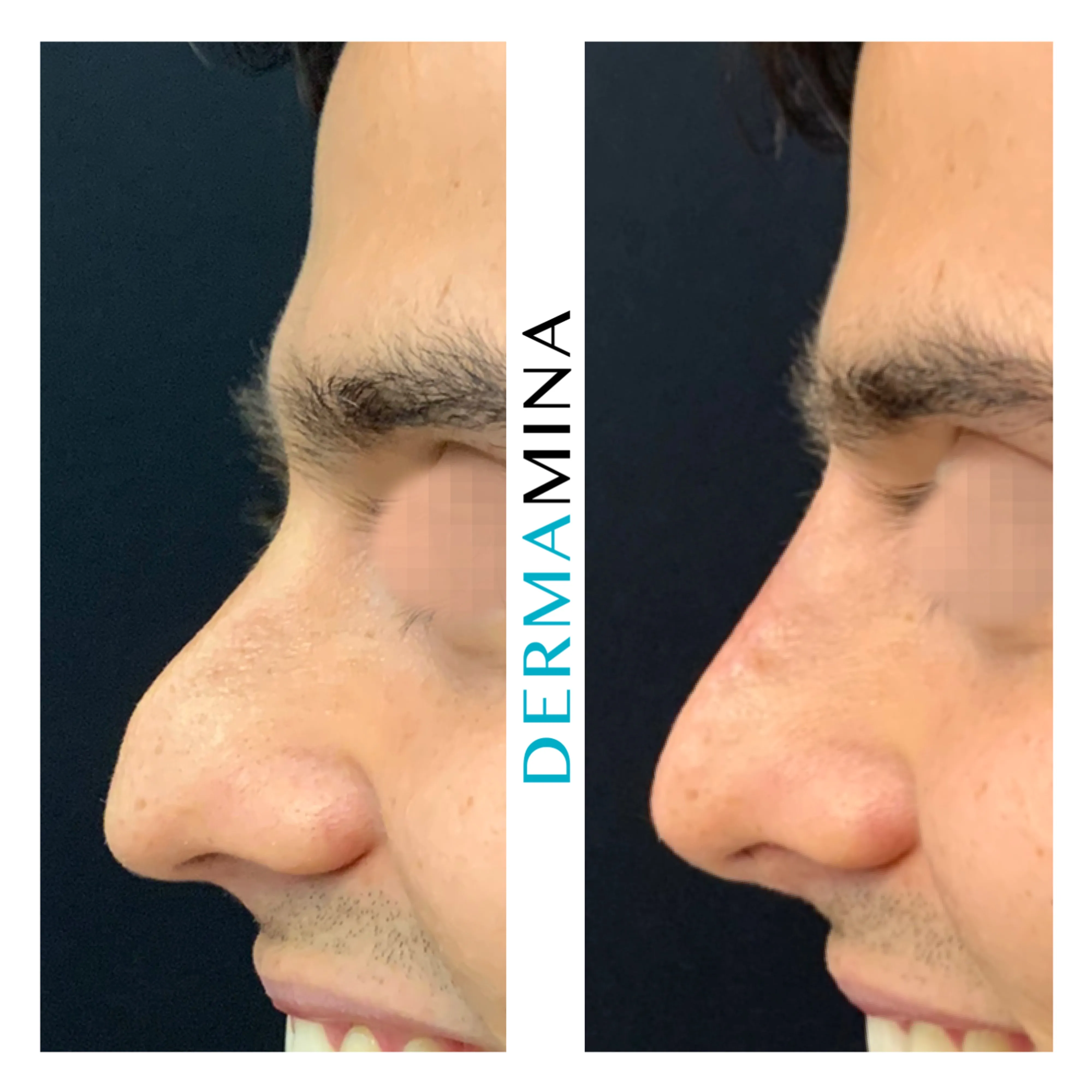 Non-surgical nose job before and after at Dermamina London, droopy tip lifted and refined