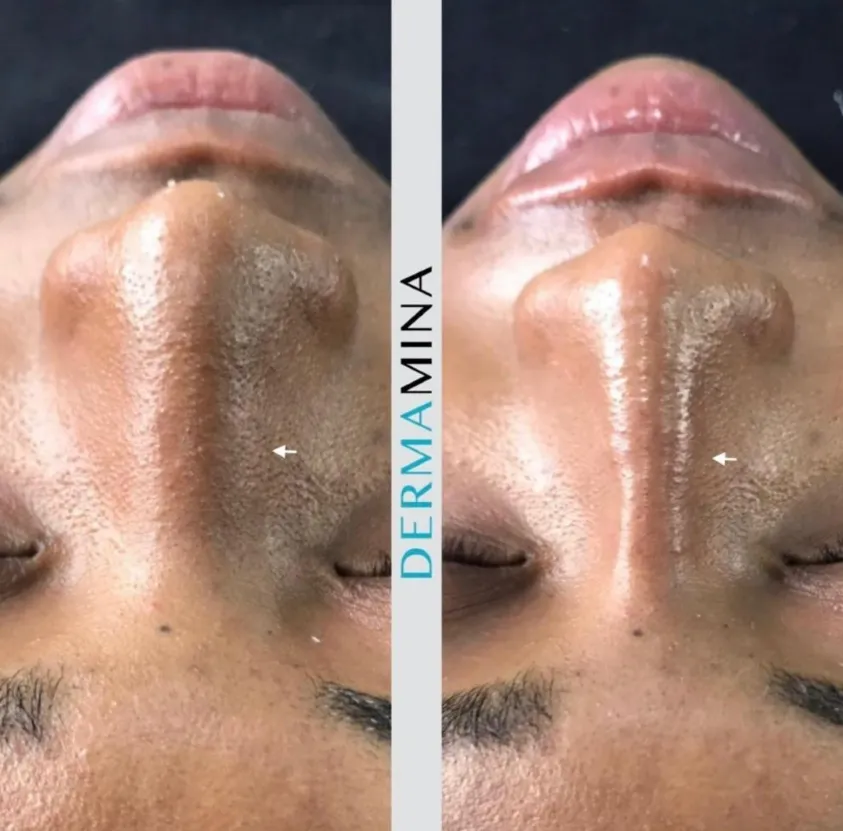 Non-surgical nose job before and after at Dermamina London, result 14