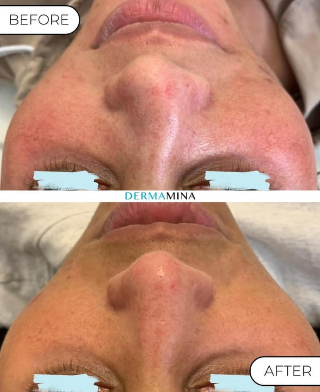 Non-surgical nose job before and after at Dermamina London, result 6