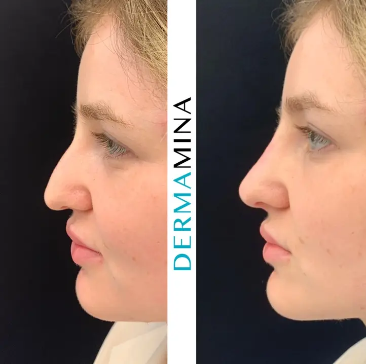 Before & After 11