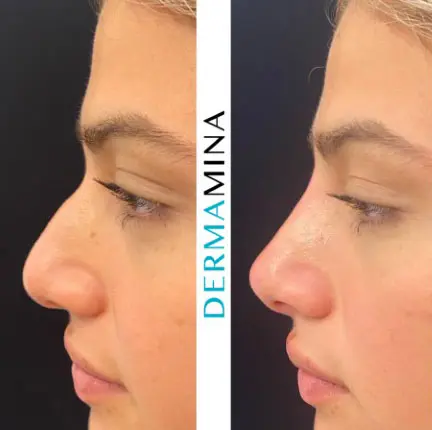 Before & After 15