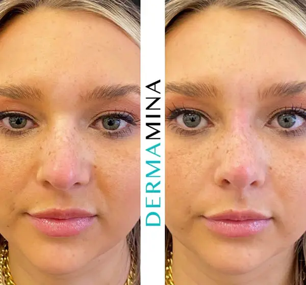 Before and after Non Surgical Rhinoplasty