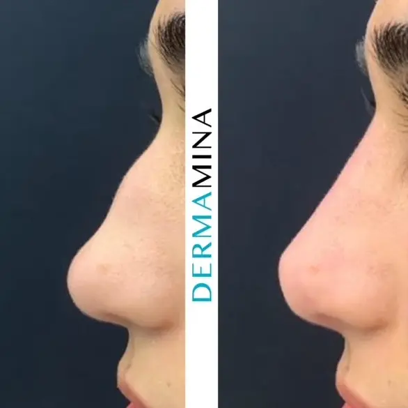 Before and after Non Surgical Rhinoplasty