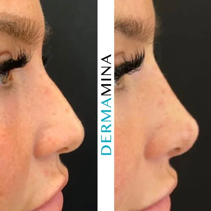 Before and after Non Surgical Rhinoplasty