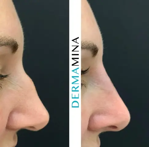 Before and after Non Surgical Rhinoplasty