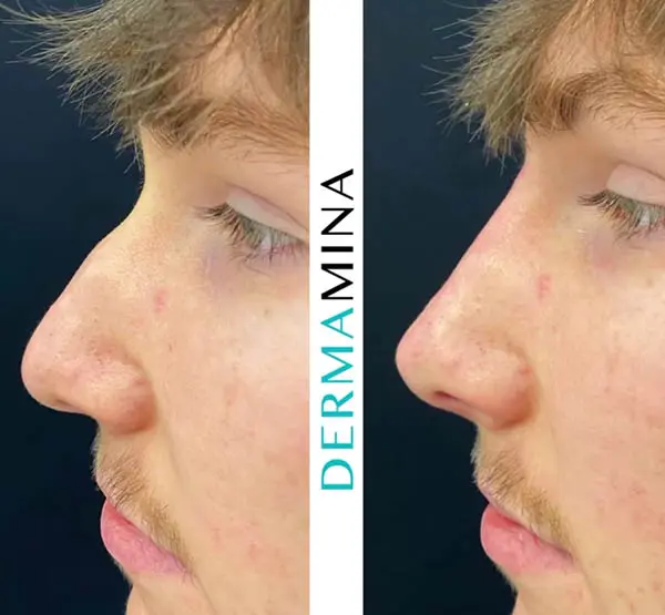 Before and after Non Surgical Rhinoplasty