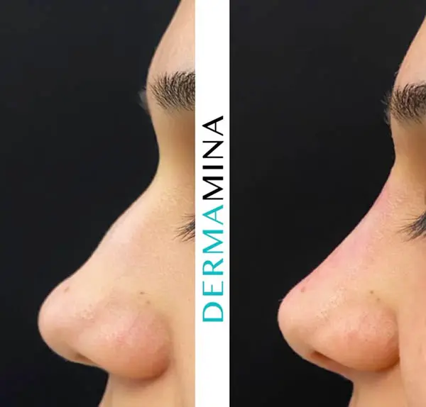 Before and after Non Surgical Rhinoplasty