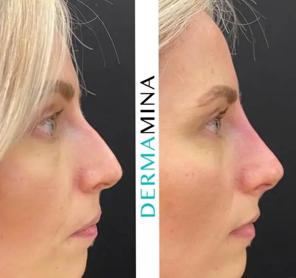 Before and after Non Surgical Rhinoplasty