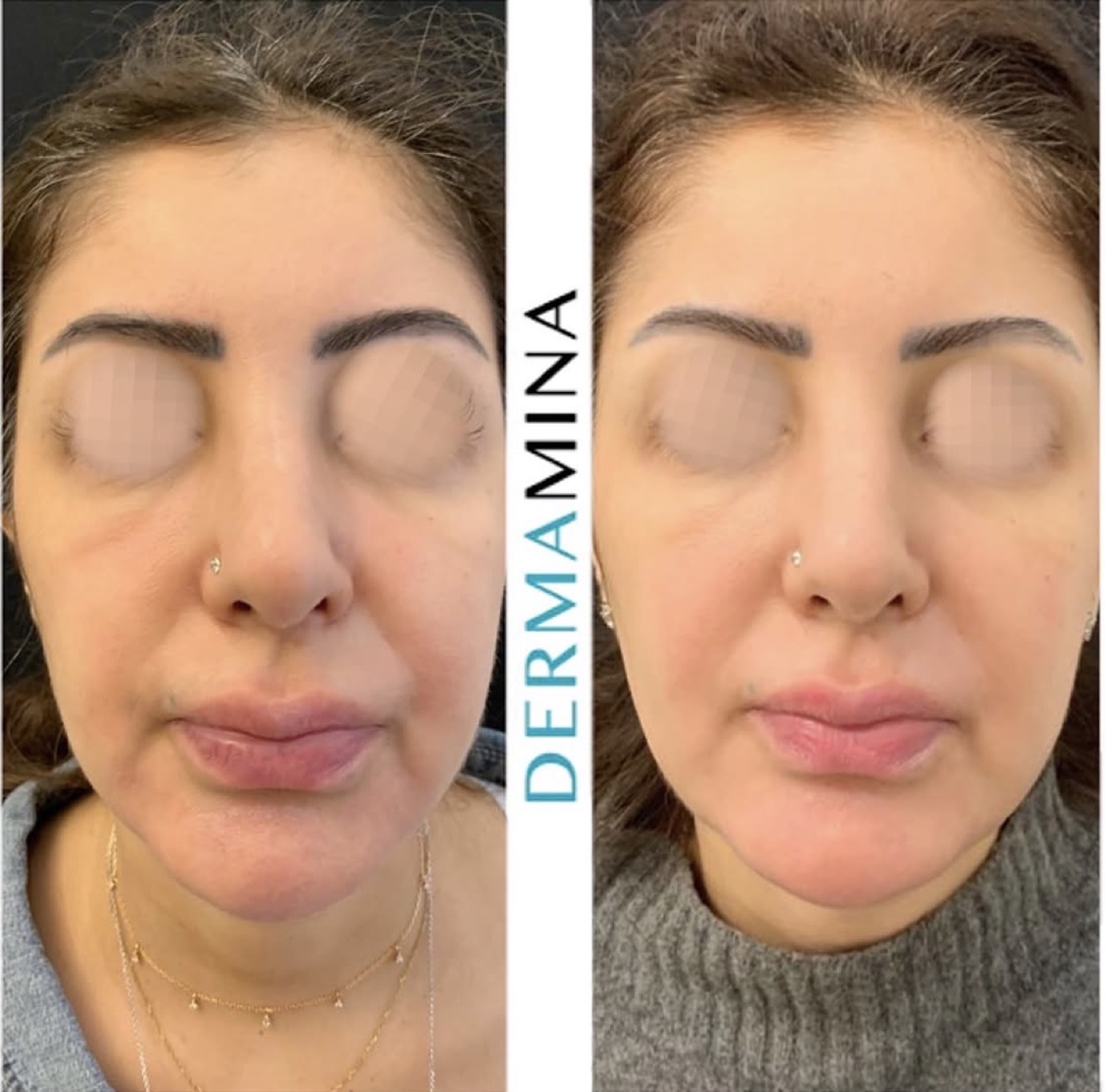 Polynucleotides before and after at Dermamina London, improved skin quality and firmness across the full face