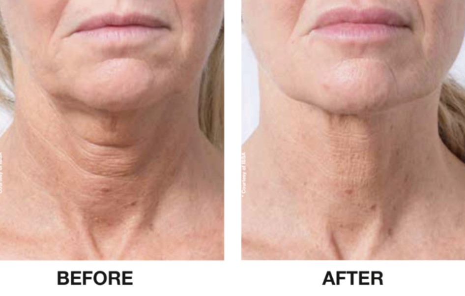 Before & After 2
