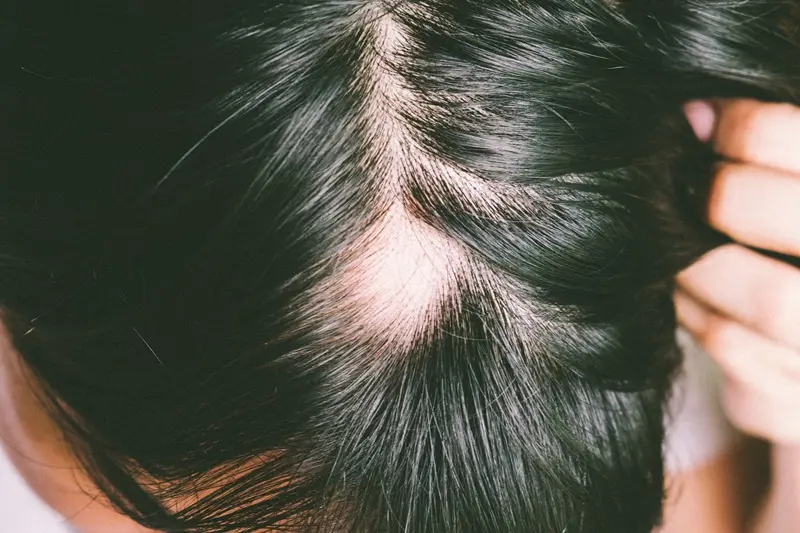Everything You Need to Know About PRP for Hair Loss: The Complete Guide — Dermamina blog