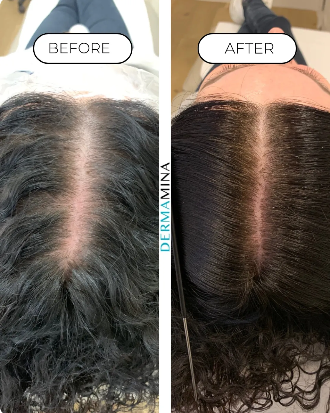 PRP hair loss before and after at Dermamina London, a widened parting filled in with denser hair