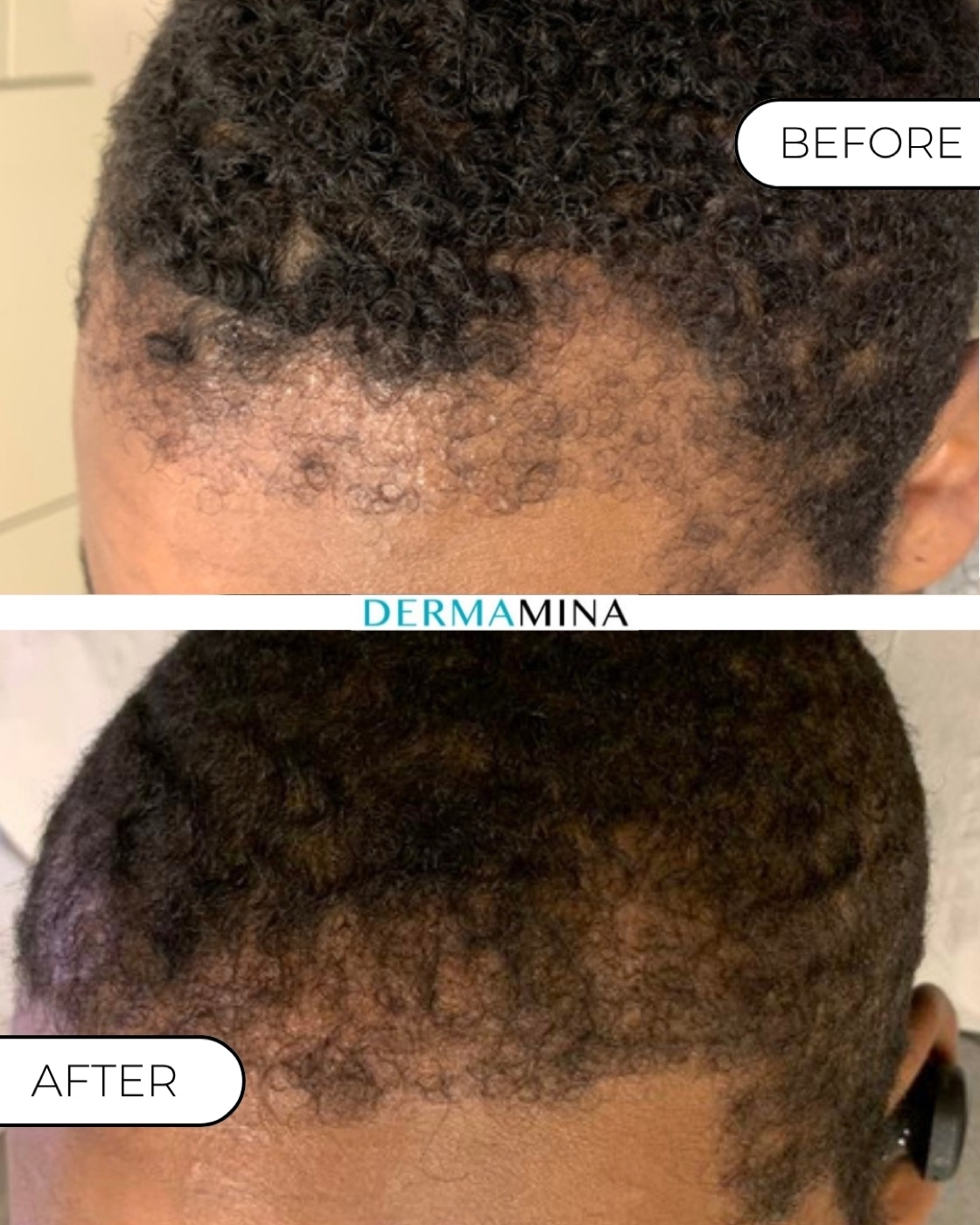 PRP hair loss before and after at Dermamina London, regrowth along a hairline affected by traction alopecia