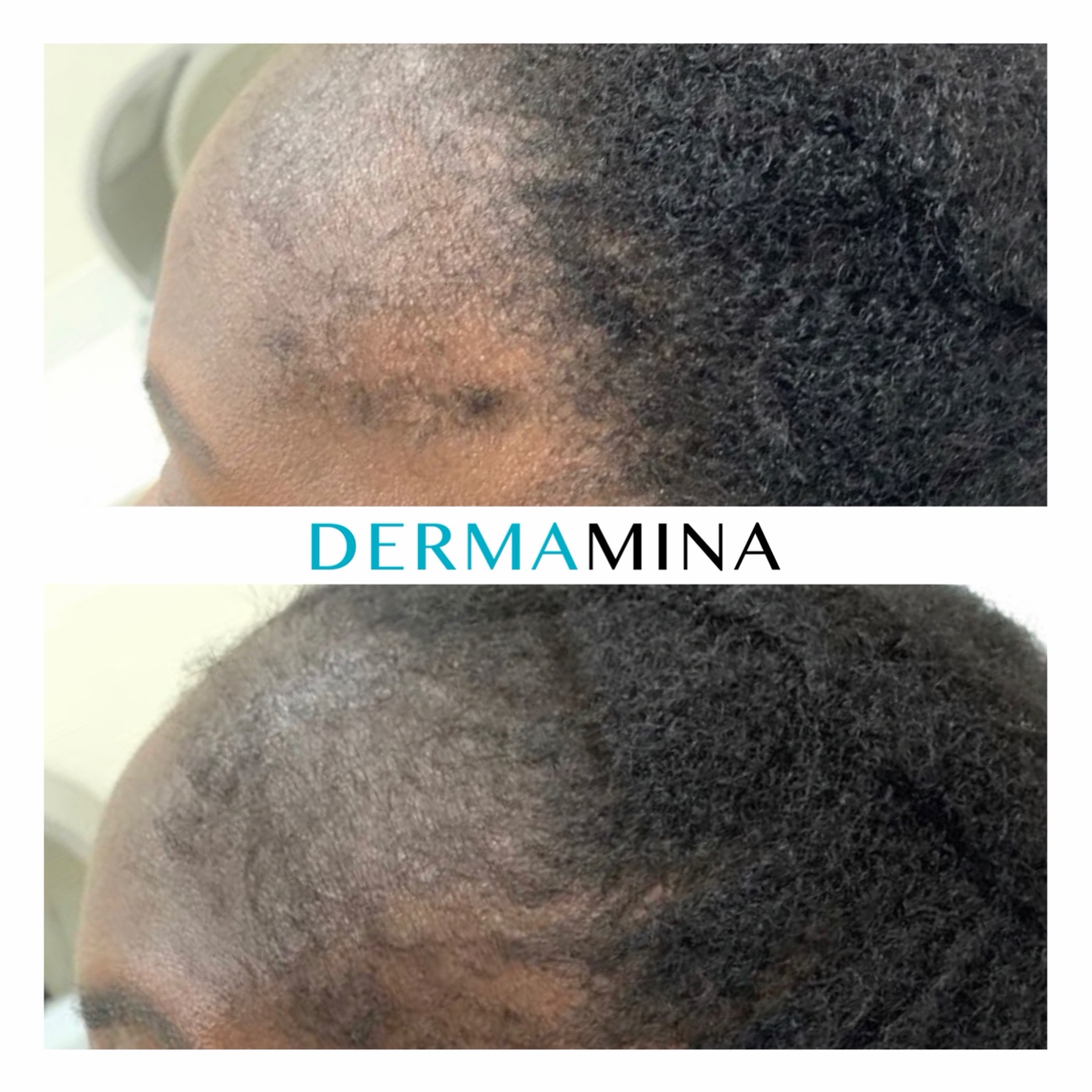 PRP hair loss before and after at Dermamina London, new growth along a thinning front hairline