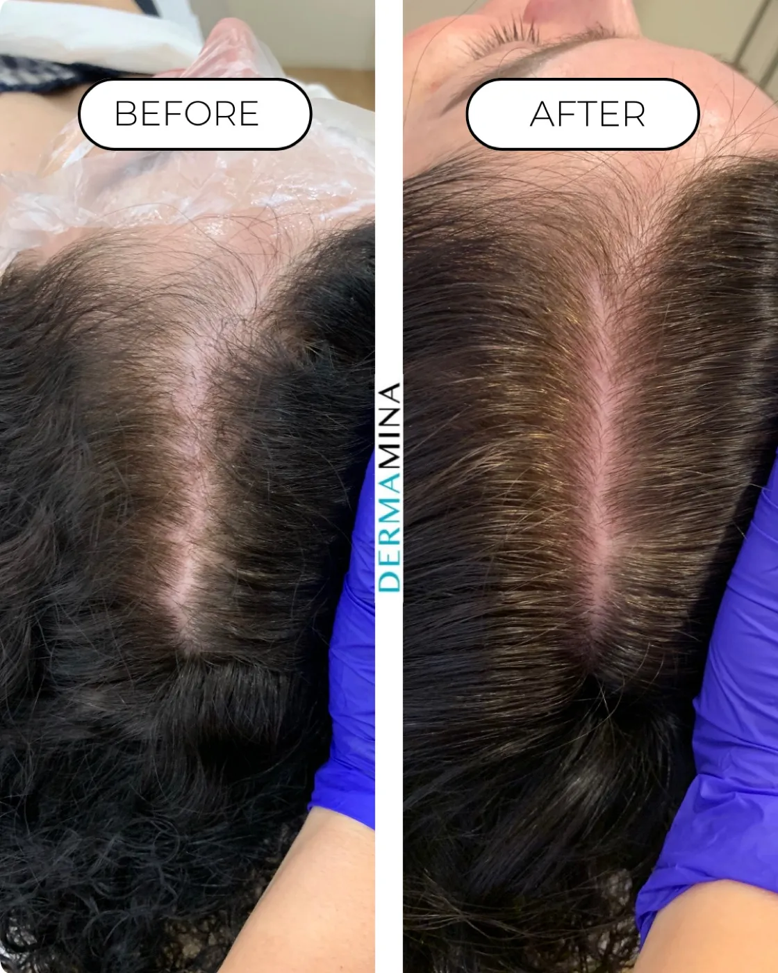 PRP hair loss before and after at Dermamina London, thicker coverage across the crown and parting