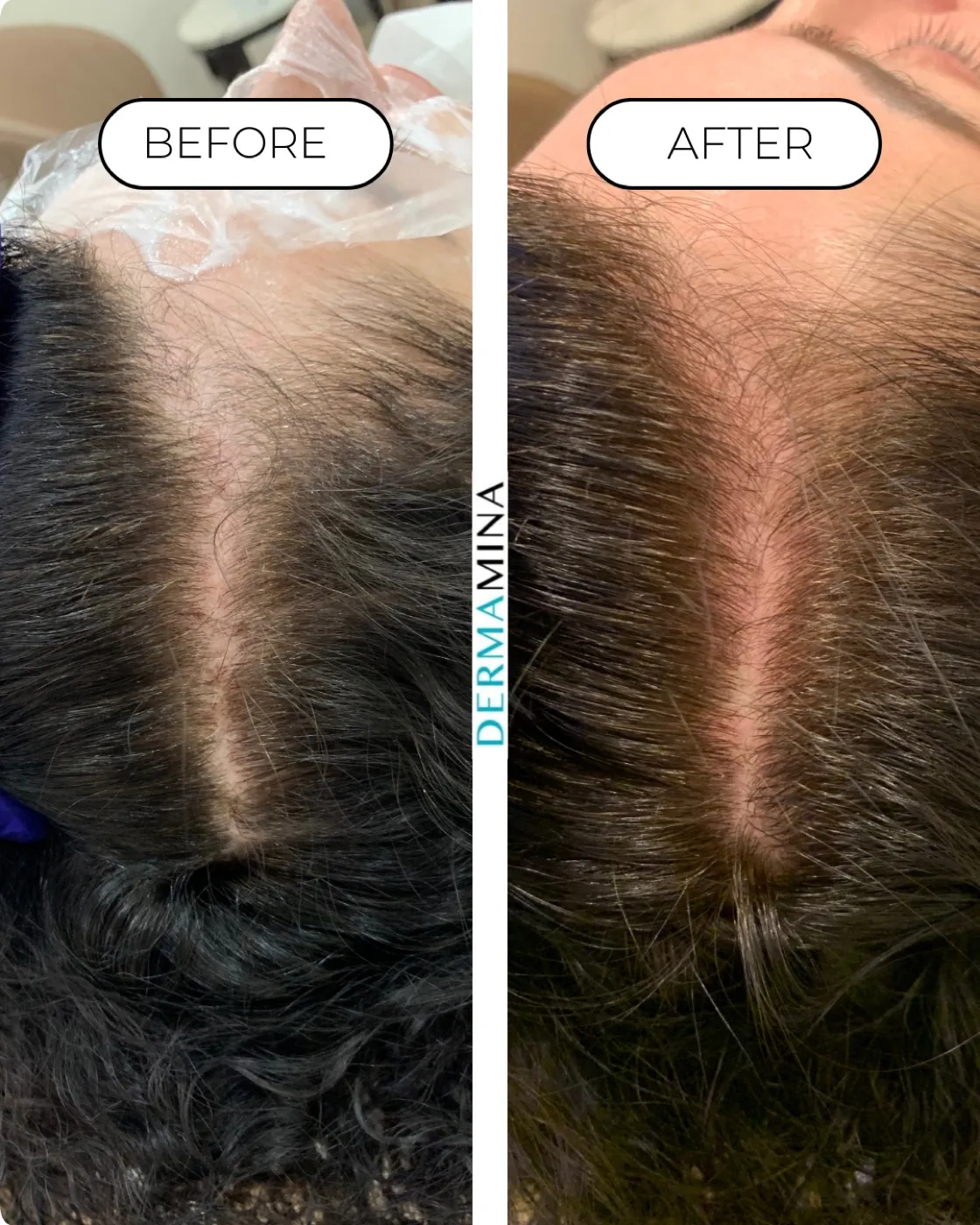 PRP hair loss before and after at Dermamina London, improved density along the front parting